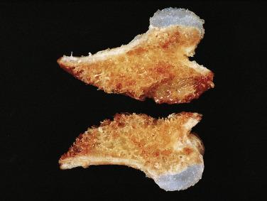 FIG. 25.12, Gross specimen of osteochondroma with a cartilaginous cap over cancellous bone.