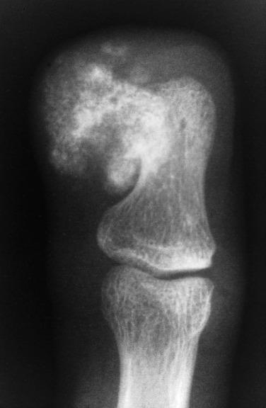 FIG. 25.14, Radiograph of bizarre parosteal osteochondromatous proliferation shows a mineralized mass attached to the surface of the distal phalanx.