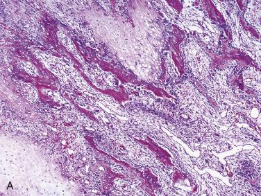 FIG. 25.16, (A) Subungual exostosis with cartilaginous tissue merging into woven bone trabeculae surrounded by loose fibrovascular connective tissue. (B) Subungual exostosis resembling osteochondroma.