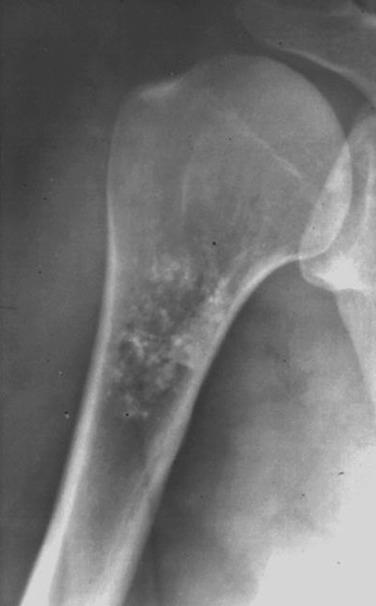 FIG. 25.17, Radiograph of an enchondroma showing a stippled pattern of matrix and no cortical changes.