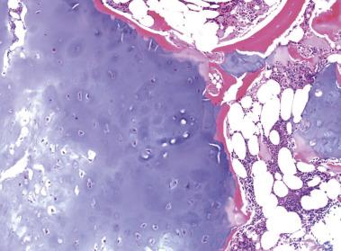 FIG. 25.18, Enchondroma demonstrating a circumscribed nodular mass of hyaline cartilage encased by a thin rim of reactive bone.