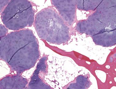 FIG. 25.19, Multiple nodules of an enchondroma growing within the medullary cavity. There is no destruction of trabecular bone.