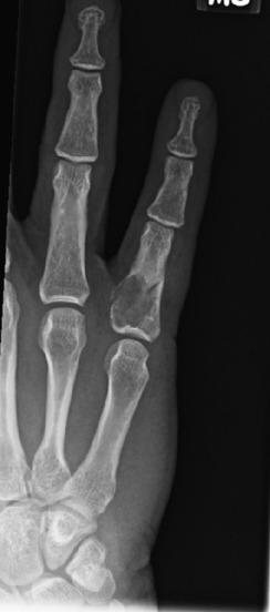 FIG. 25.20, Radiograph of an enchondroma involving the proximal phalanx of the ring finger forming a circumscribed lytic mass associated with a pathologic fracture.