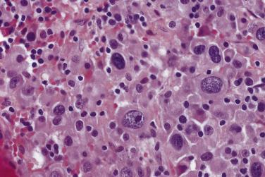 FIG. 25.2, Poorly differentiated myeloma contains some larger atypical plasma cells that may resemble immunoblasts seen in lymphoma.