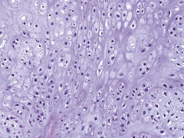 FIG. 25.21, Histologic features of the enchondroma in Fig. 25.20 . The tumor is hypercellular with nuclear hyperchromasia when compared to an enchondroma involving a long bone.