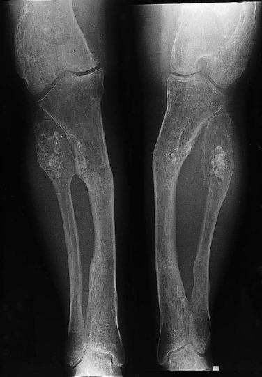 FIG. 25.22, Radiograph of both lower legs shows dysplastic changes typical of Ollier disease in the metadiaphyseal region of the long bones, with associated bowing deformity. Multiple cartilaginous lesions are present, consistent with multiple enchondromas.