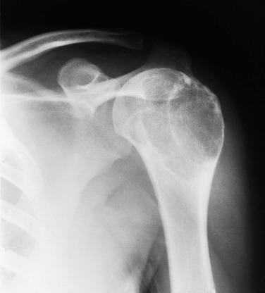 FIG. 25.23, Radiograph of chondroblastoma arising in the apophysis of the humerus shows an expansile appearance with surrounding sclerosis.