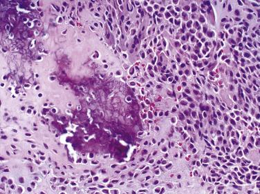 FIG. 25.24, Typical chondroblastoma illustrates eosinophilic chondroid matrix with calcific deposits. The mononuclear cells contain round-to-oval nuclei surrounded by pink cytoplasm.