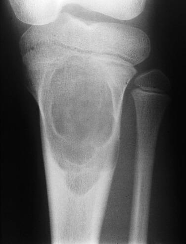 FIG. 25.25, Radiograph of chondromyxoid fibroma arising within the metaphysis of the proximal tibia. The lesion has a sclerotic and scalloped rim, typical of chondromyxoid fibroma.