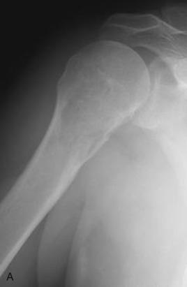 FIG. 25.27, AP radiograph (A), axial CT (B), sagittal T2 MRI (C), and sagittal gadolinium-enhanced MRI (D) of the proximal right humerus of a 58-year-old male show findings of a chondrosarcoma presenting as a lytic destructive lesion in the metadiaphysis with a wide zone of transition and associated cortical permeation medially. The chondroid matrix is better appreciated on CT where there are stippled calcifications in the medullary canal. The T2-weighted MRI shows a predominantly hyperintense lesion with scattered nodularity that involves a longer segment of the bone than predicted on the radiographs. The gadolinum-enhanced MR image shows the typical enhancement pattern of chondrosarcoma with septal and peripheral nodular enhancement surrounding large regions of nonenhancement suggestive of myxoid change.