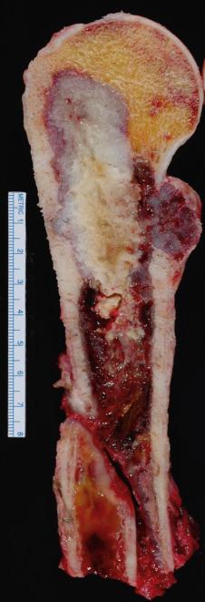 FIG. 25.28, Gross specimen of chondrosarcoma with a pathologic fracture. Intramedullary tumor shows the typical grey-white color of hyaline cartilage, and the nodular mass breaking through the cortex has a glistening myxoid appearance characteristic of chondrosarcoma.