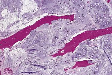 FIG. 25.29, Grade 1 chondrosarcoma permeates around preexisting trabecular bone.