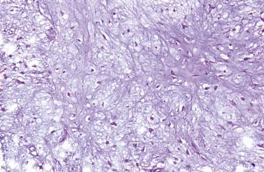 FIG. 25.30, Liquifactive myxoid change in a chondrosarcoma.