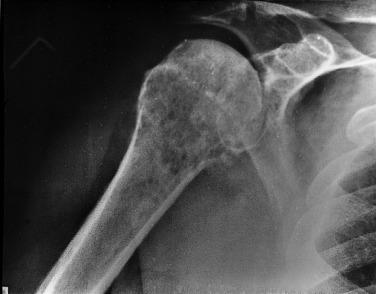 FIG. 25.3, Radiograph of a lymphoma forming an ill-defined, lytic, and destructive lesion in the proximal humeral metaphysis.