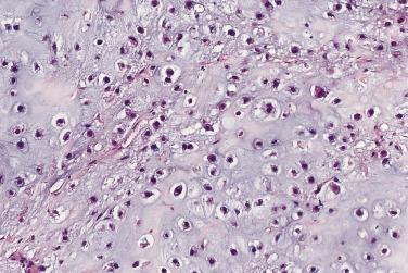 FIG. 25.31, Grade 2 chondrosarcoma shows a greater degree of nuclear atypia and hypercellularity than grade 1 chondrosarcoma.