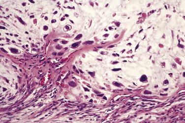 FIG. 25.32, Grade 3 chondrosarcoma illustrates marked nuclear hyperchromasia and pleomorphism.