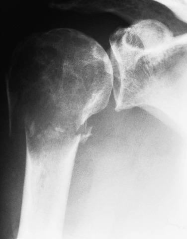 FIG. 25.34, Clear cell chondrosarcoma of the proximal humerus. There is expansion with extension to the end of the bone.