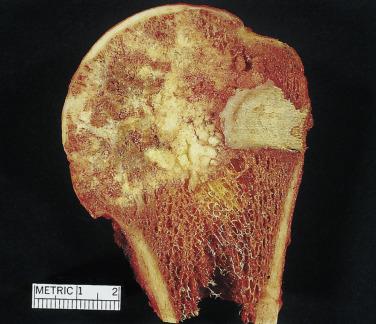 FIG. 25.35, Gross specimen of clear cell chondrosarcoma is heavily mineralized and extends to the end of the bone.