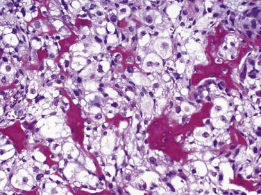 FIG. 25.36, Clear cell chondrosarcoma shows woven bone, distinct cell boundaries, abundant clear cytoplasm, and scattered prominent nucleoli.