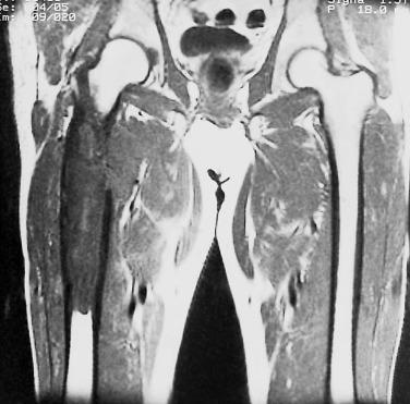 FIG. 25.37, Magnetic resonance image of a dedifferentiated chondrosarcoma arising within the femur. The lesion is diametaphyseal, with extensive cortical destruction and associated soft tissue extension of the tumor.