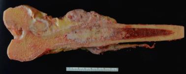 FIG. 25.38, Gross specimen of dedifferentiated chondrosarcoma. The grey-white color of hyaline cartilage is seen within the intraosseous component. This differs from the soft tan-grey appearance of the extraosseous high grade sarcoma.