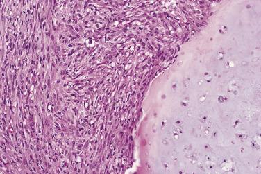 FIG. 25.39, Dedifferentiated chondrosarcoma shows the hyaline cartilage portion of the tumor (right) with features of a low-grade chondrosarcoma juxtaposed with a high-grade spindle cell sarcoma (left).