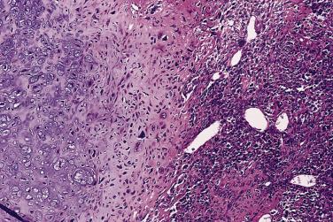 FIG. 25.40, Mesenchymal chondrosarcoma shows a malignant cartilaginous nodule merging with a hypercellular region of small cells.