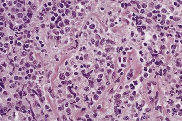 FIG. 25.4, Primary bone lymphoma demonstrating cytologic variability with irregular nuclear outlines and fine fibrosis weaving among the tumor cells.