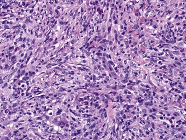 FIG. 25.5, Primary bone lymphoma resembling sarcoma. Immunohistochemical stains showed diffuse positivity for CD20, indicating a B-cell phenotype.