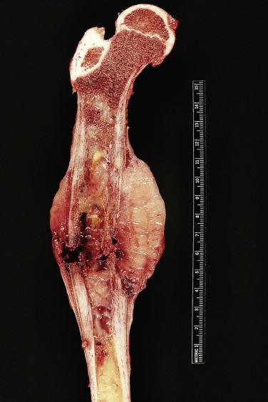 FIG. 25.7, Gross specimen of Ewing sarcoma shows a pathologic fracture and a soft gray-white mass extending into soft tissue.