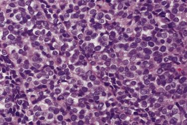 FIG. 25.8, Ewing sarcoma shows a uniform population of cells composed of round-to-oval nuclei with a finely granular chromatin pattern.