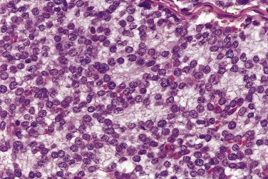 FIG. 25.9, Ewing sarcoma showing prominent rosette formation.