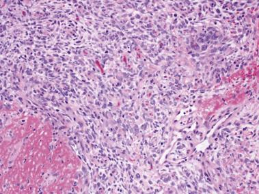 FIG. 25.10, Small round cell sarcoma (Ewing sarcoma–like) with BCOR-CCNB3 fusion, showing areas of spindle cell morphology.