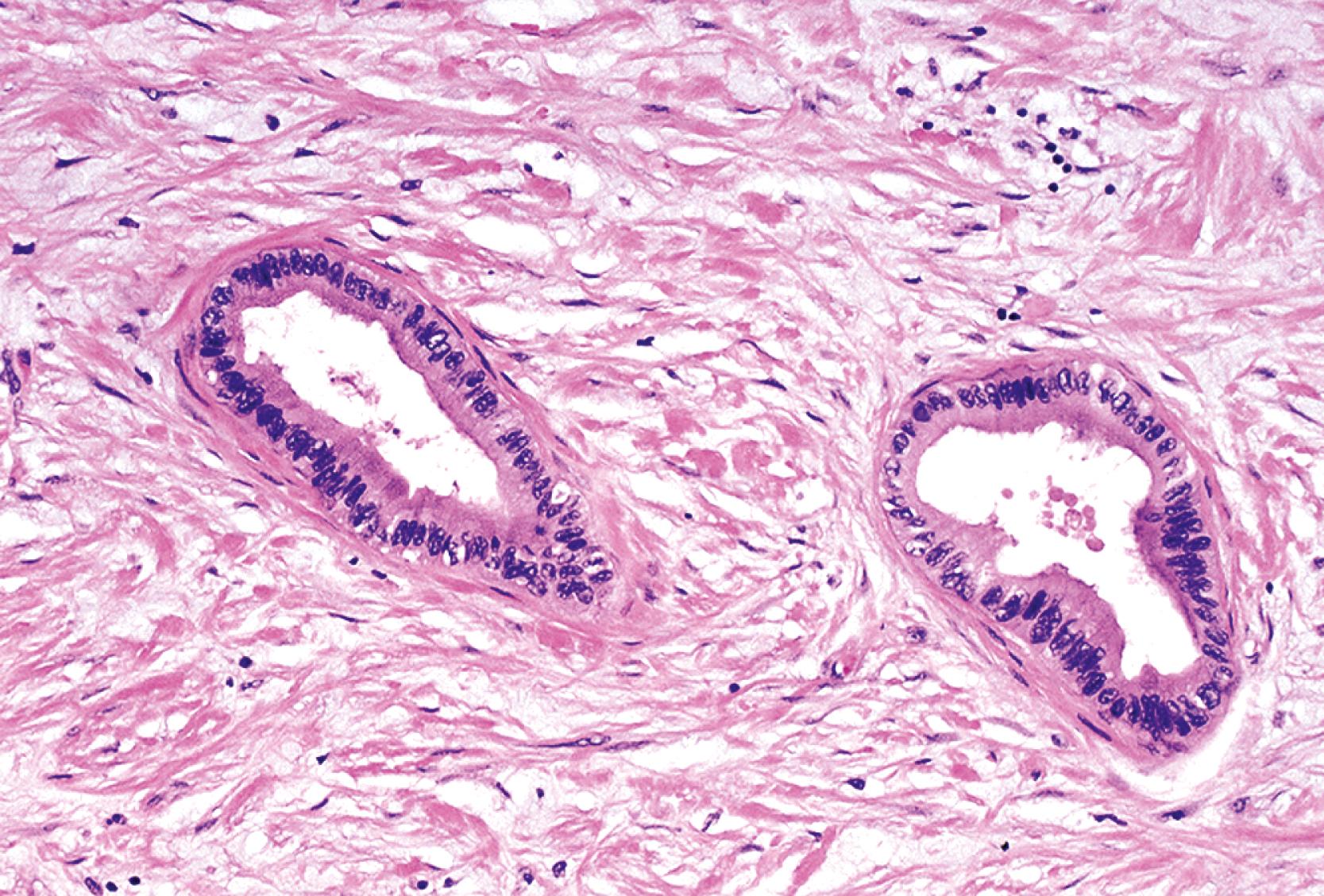 FIGURE 41.4, Well-differentiated ductal adenocarcinoma. Some infiltrating carcinomas consist of remarkably well-formed glands and exhibit relatively minimal cytological atypia, mimicking benign ductules.