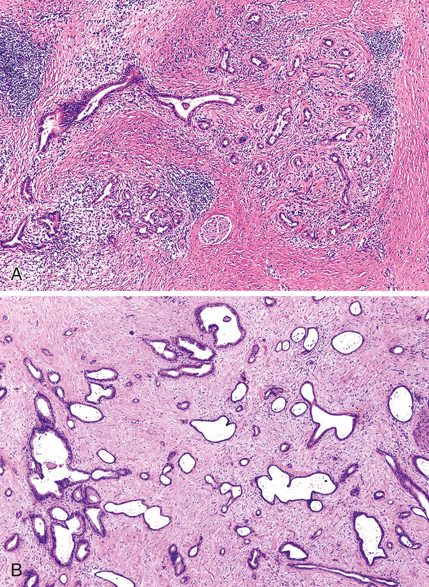 FIGURE 41.7, Comparison between atrophic chronic pancreatitis and well-differentiated ductal adenocarcinoma.