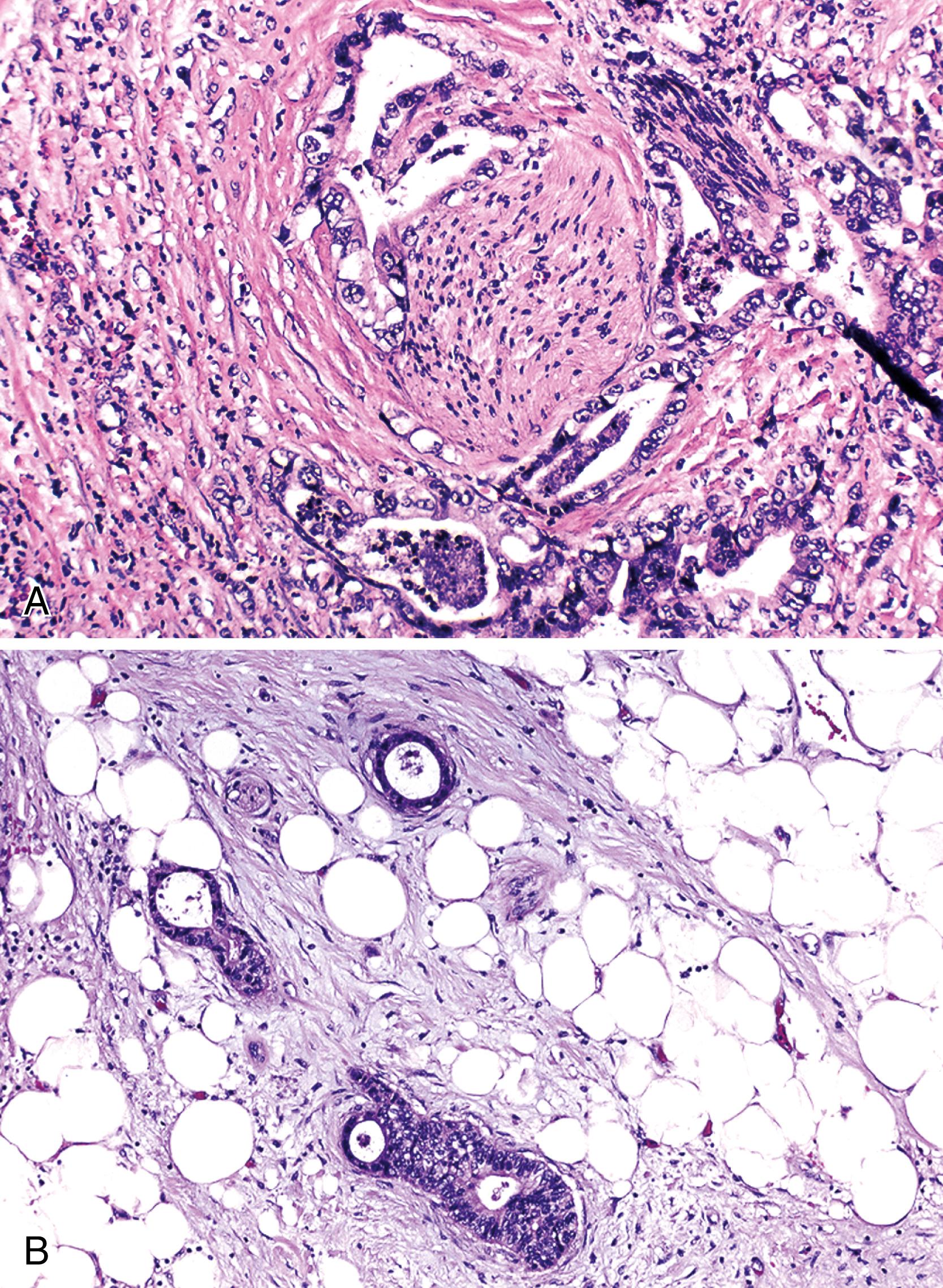 FIGURE 41.8, Findings diagnostic of ductal adenocarcinoma.