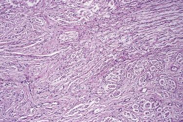 FIG. 27.1, Traumatic neuroma. Note the irregular admixture of nerve fibers and fibrous tissue. The edematous end of the damaged nerve is evident in the top right corner.