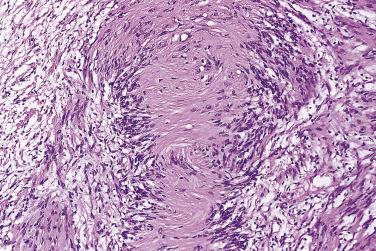 FIG. 27.11, Benign schwannoma. A typical Verocay body.