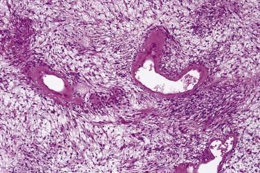 FIG. 27.12, Benign schwannoma. Note the myxoid matrix and hyaline vessel walls in the Antoni B area.