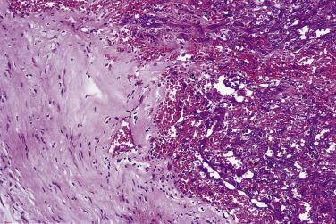 FIG. 27.14, Epithelioid angiosarcoma arising in benign schwannoma. Note the abrupt transition between the two components.