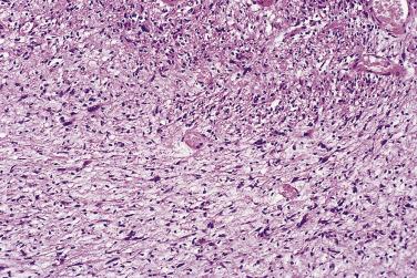 FIG. 27.15, Ancient schwannoma. Note the nuclear atypia.