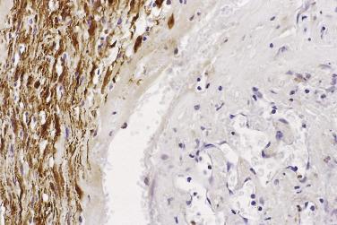 FIG. 27.16, Ancient schwannoma. This very hyalinized, pseudovascular lesion contained only small foci of residual S100-positive Schwann cells.