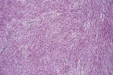 FIG. 27.17, Cellular schwannoma. Note the uniformly eosinophilic fascicular growth pattern.