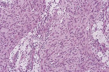 FIG. 27.18, Cellular schwannoma. Aggregates of foamy histiocytes are present in many cases.