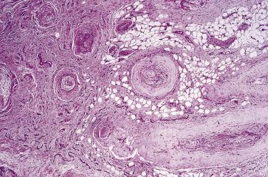 FIG. 27.2, Morton metatarsalgia. Note the marked perineurial and endoneurial fibrosis.