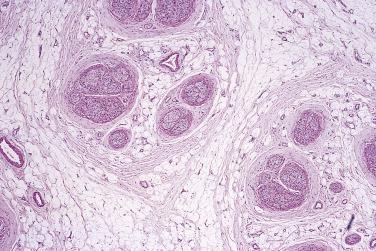 FIG. 27.4, Fibrolipomatous hamartoma of nerve. The epineurium is expanded by fibroadipose tissue.