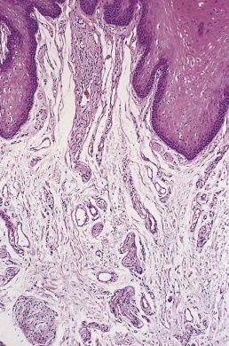 FIG. 27.5, Mucosal neuroma. Numerous nerve fibers of varying size are present in the submucosa.