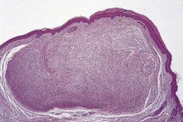 FIG. 27.6, Solitary circumscribed neuroma. Note the lack of a capsule superficially and the nerve of origin in the bottom right corner.