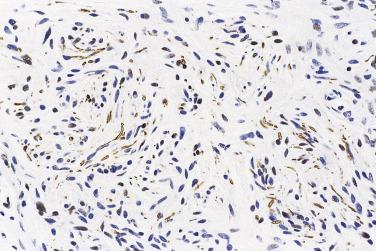 FIG. 27.8, Solitary circumscribed neuroma. Note the innumerable small axons demonstrated by this neurofilament stain.