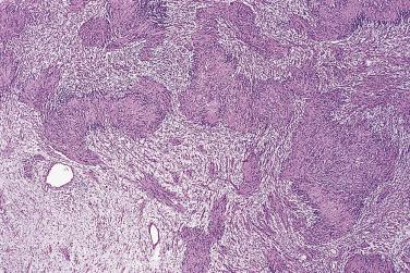 FIG. 27.9, Benign schwannoma. This case has a typically biphasic appearance.